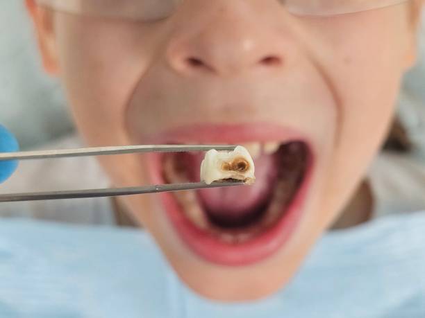 Best Cracked Tooth Emergency Dentist  in Tieton, WA